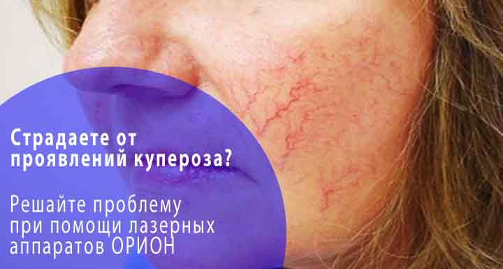 Что вызывает купероз на лице?